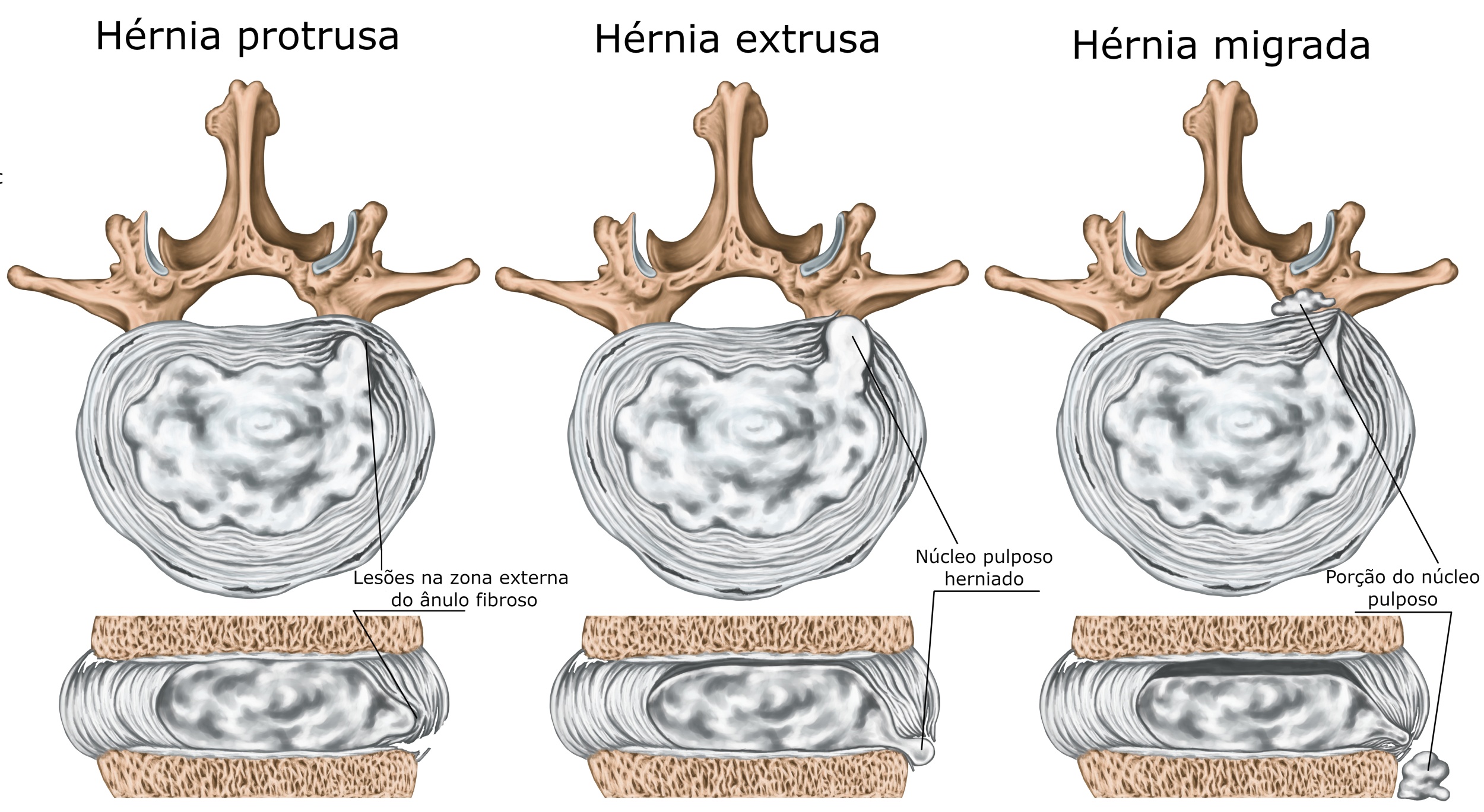 Hernia De Disco Cervical O Hernia Discal Cervical Que Vrogue Co