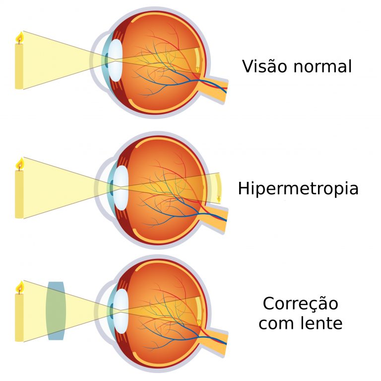 professora-evelyn-hipermetropia